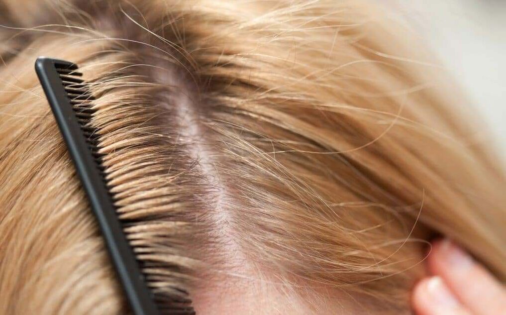 τύπος ψωρίασης